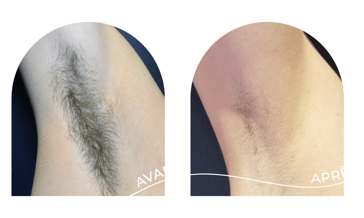 innovaderm-esthetique-epilation-avant-apres