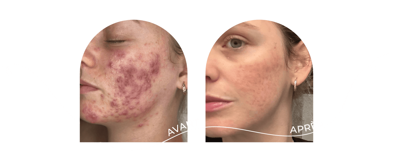 innovaderm-esthetique-acne-avant-apres