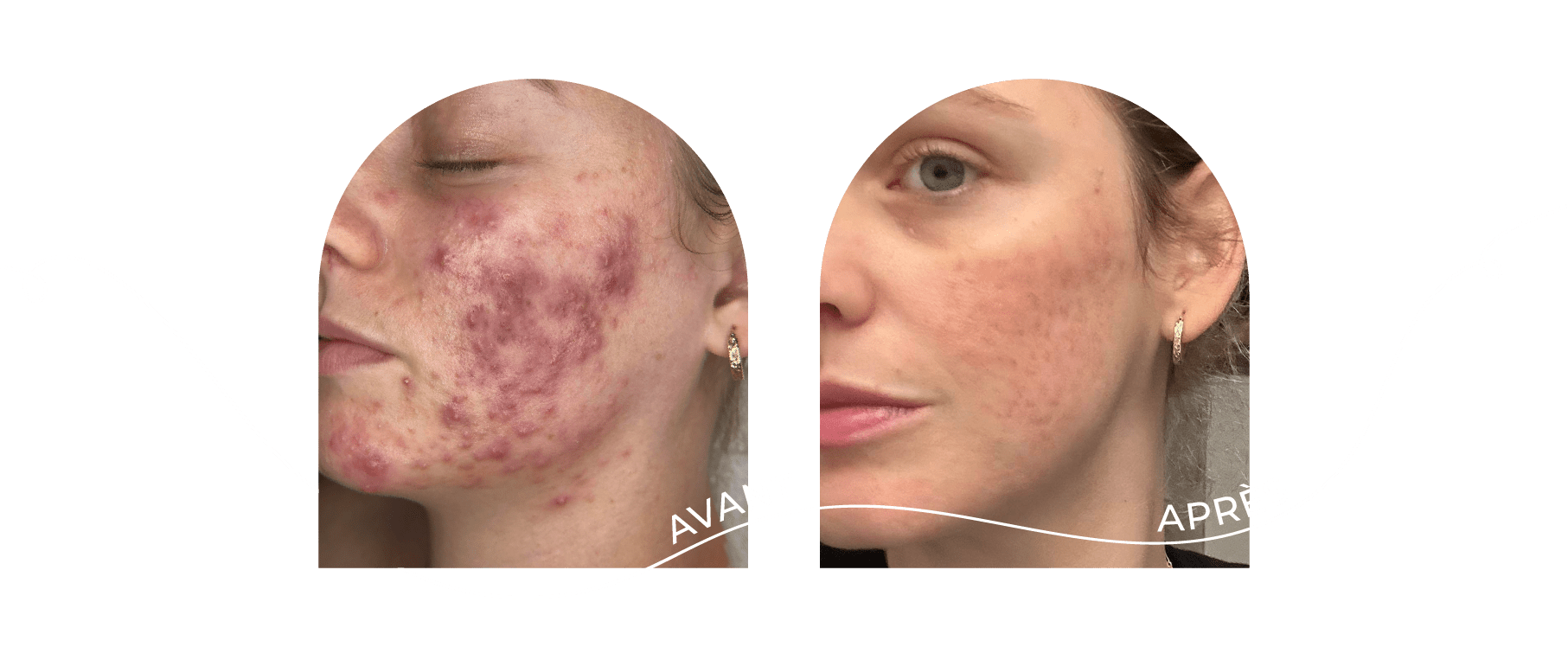 innovaderm-esthetique-acne-avant-apres