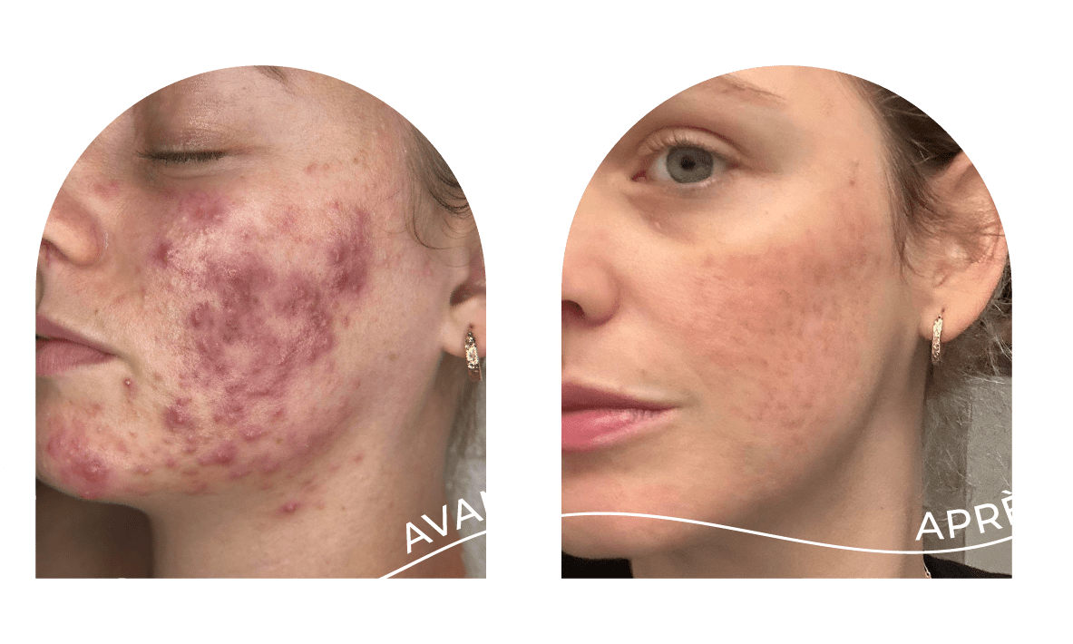 innovaderm-esthetique-acne-avant-apres