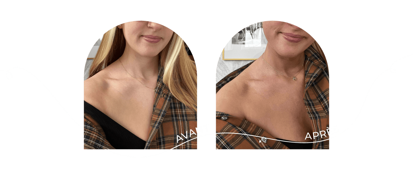innovaderm-esthetique-bronzage-avant-apres