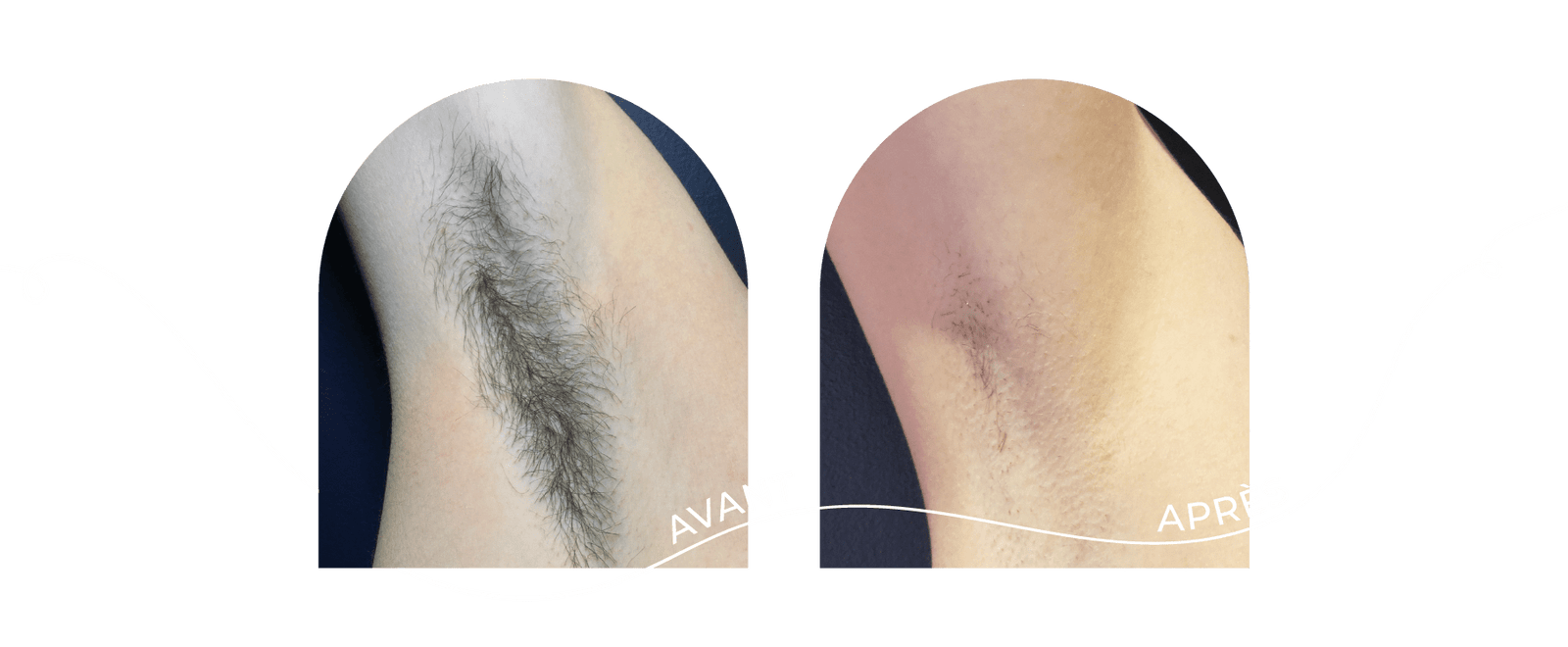 innovaderm-esthetique-epilation-avant-apres