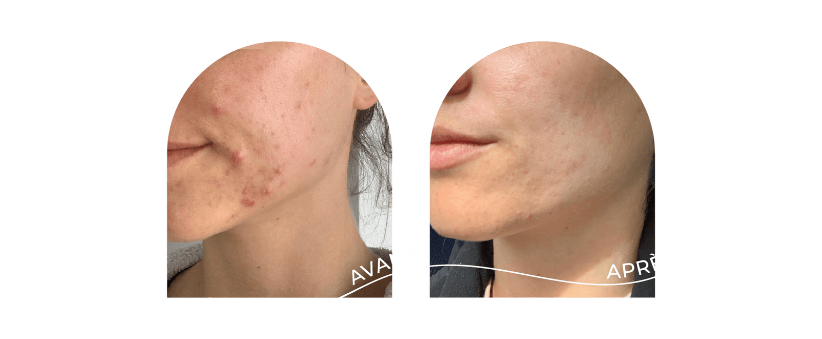 innovaderm-esthetique-nettoyage-profondeur