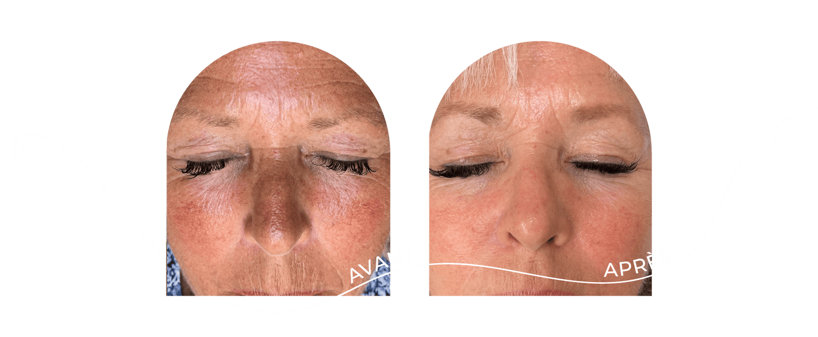 innovaderm-esthetique-rajeunissement-peau-avant-apres