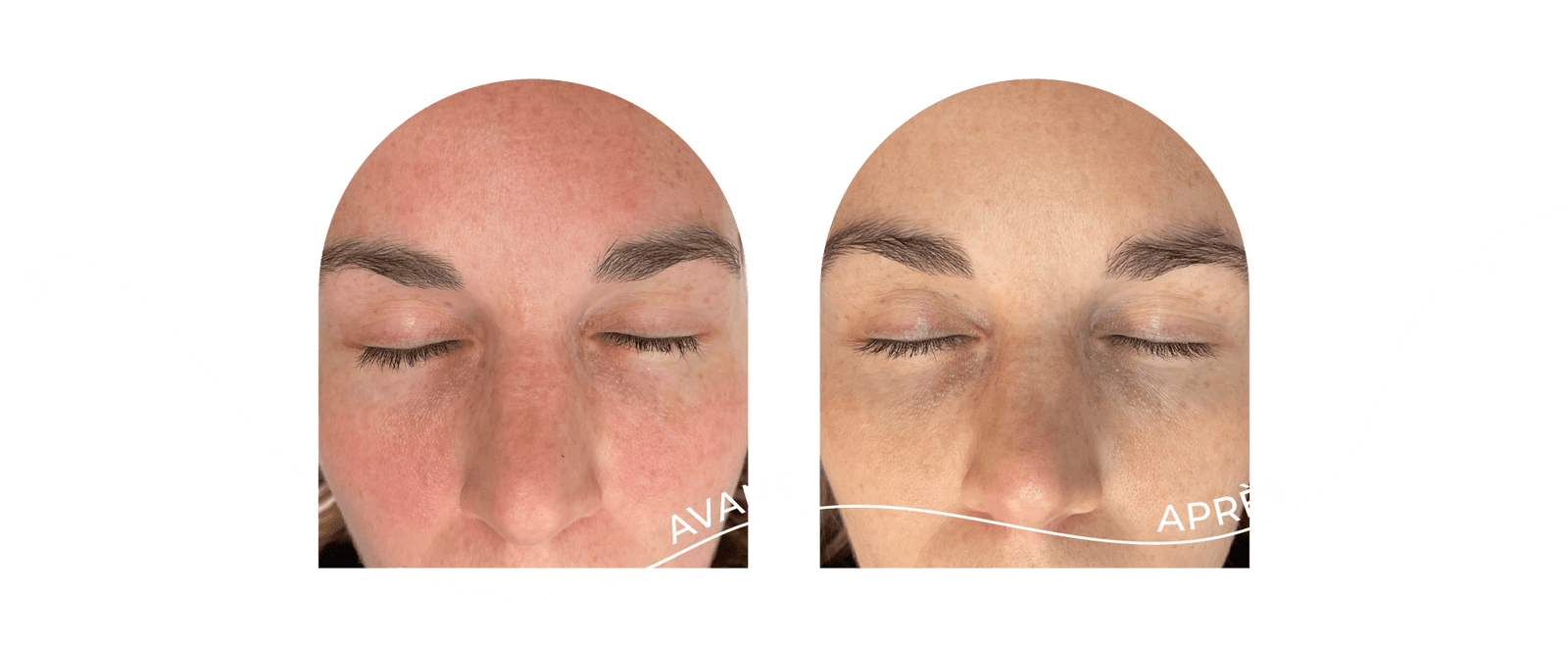 innovaderm-esthetique-rougeurs-avant-apres
