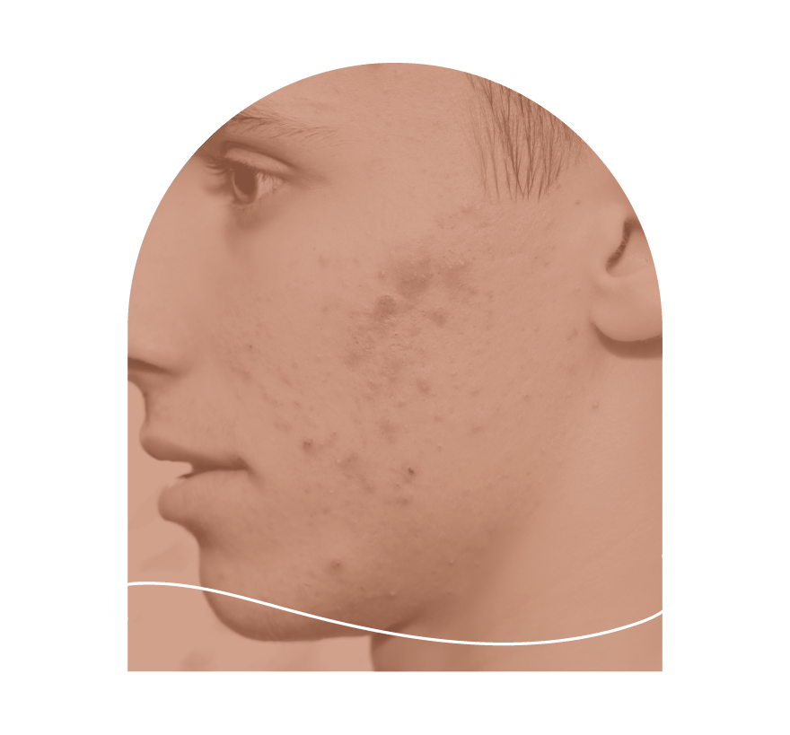 innovaderm-esthetique_acne-bouton