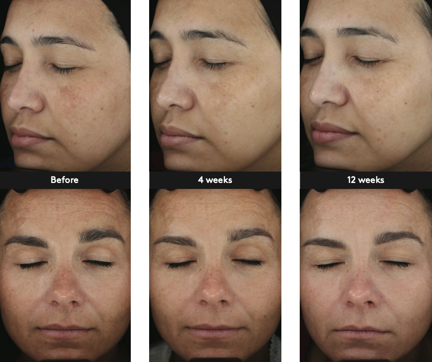L’évolution de 2 différents visages en 3 phases après l’utilisation de sérum even up par colorescience 